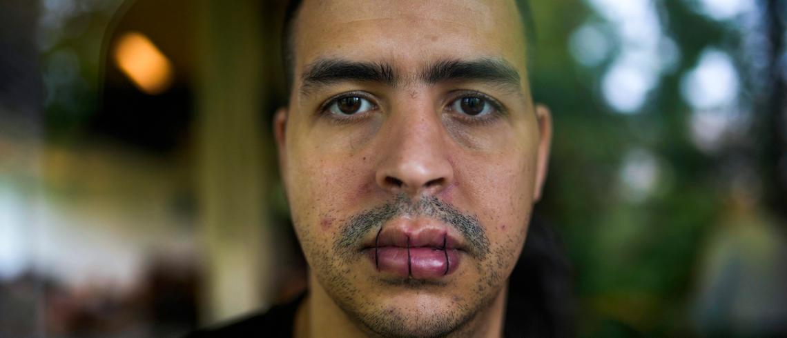 Stitched Lips Why Are Migrants On Hunger Strike In Belgium