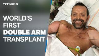 Man undergoes world’s first double arm transplant