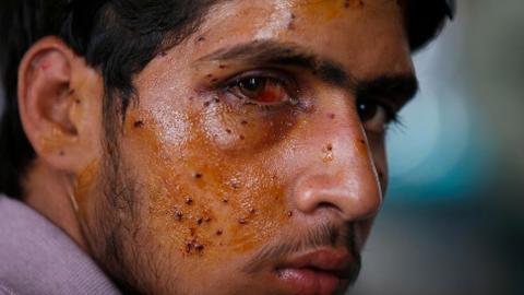Ban shotguns maiming Kashmiris, Amnesty tells India