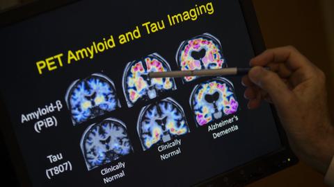 Alzheimer's drug succeeds in 'slowing' cognitive decline
