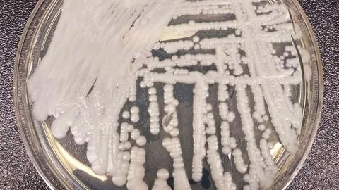 Dangerous Candida auris fungus now reported in more than half of US states
