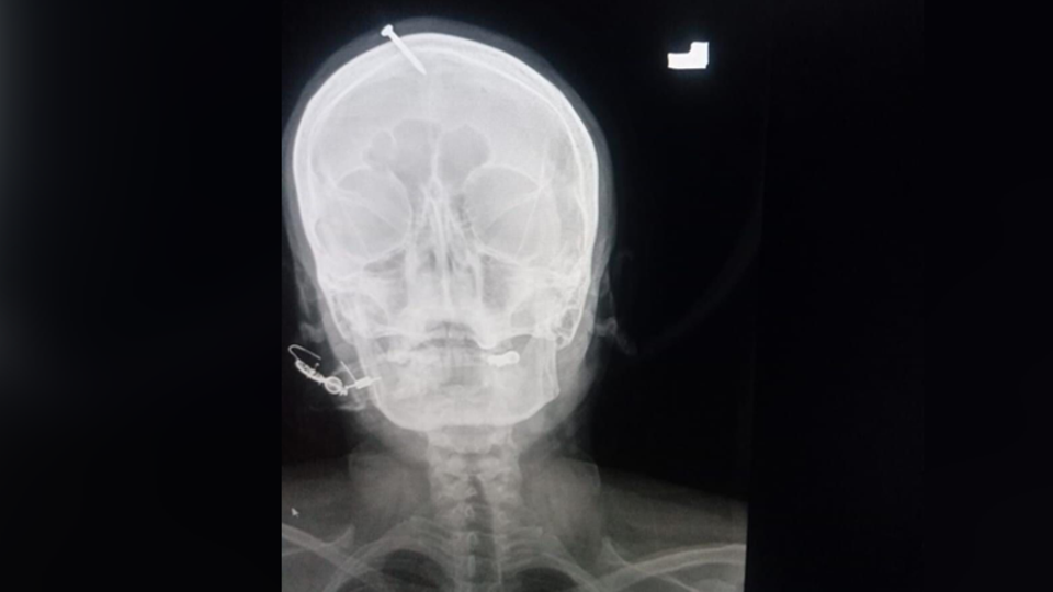 An X-ray shows the nail in the head of the Pakistani woman.