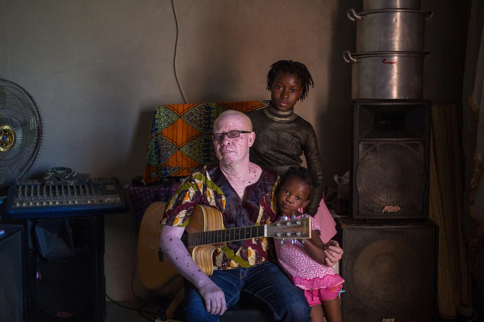 Violent Crimes Against Albinos Are On The Rise In Sub Saharan Africa