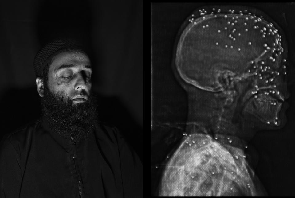 Amir, 28 years old, from Baramulla. First reported pellet victim in Kashmir, lost vision in both eyes in 2010.