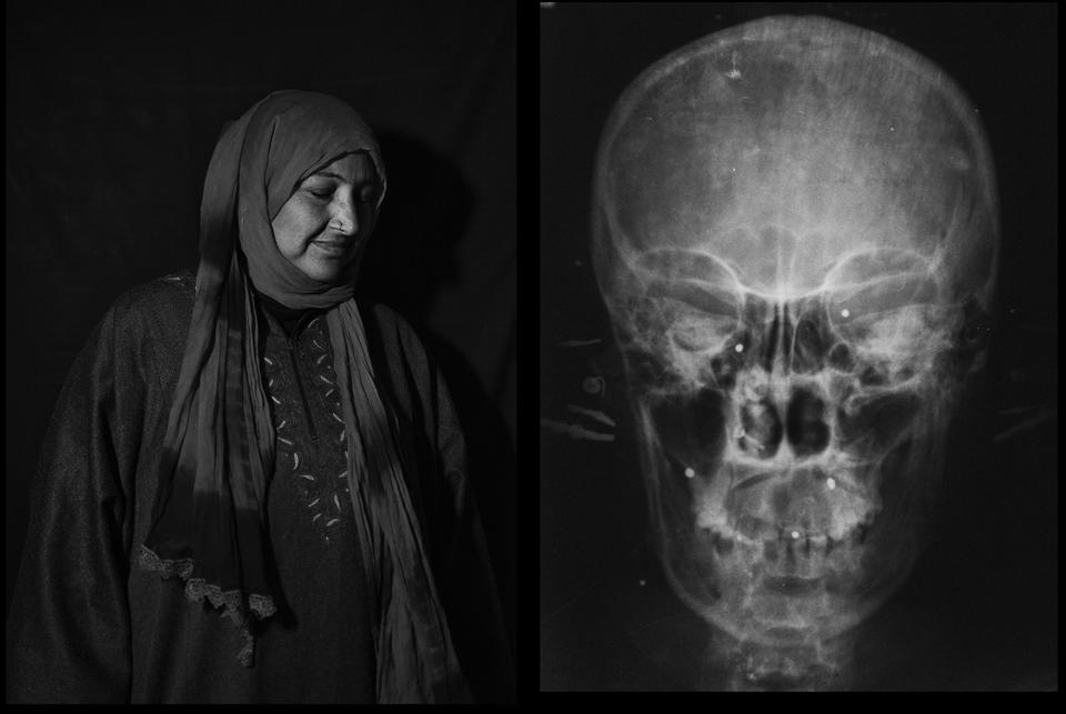 Shakeela Begum, 35-years-old, when she was shot, from Sheeri. Shakeela was hit by dozens of pellets on the chest, one in the left eye and two in the right eye.  She is left with just ten percent of her vision.